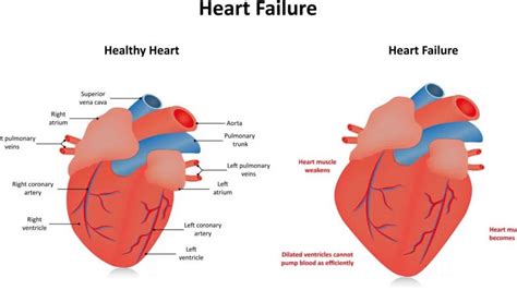 does hypokinesis mean heart failure.